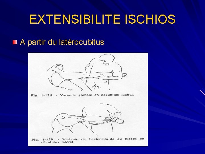 EXTENSIBILITE ISCHIOS A partir du latérocubitus 