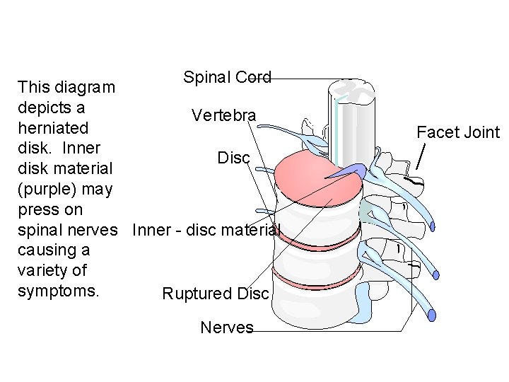 Spinal Cord This diagram depicts a Vertebra herniated disk. Inner Disc disk material (purple)