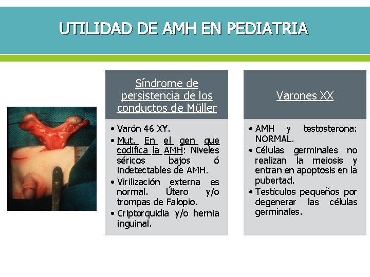 UTILIDAD DE AMH EN PEDIATRIA Síndrome de persistencia de los conductos de Müller •