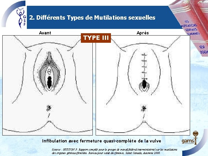 2. Différents Types de Mutilations sexuelles Avant TYPE III Après Infibulation avec fermeture quasi-complète