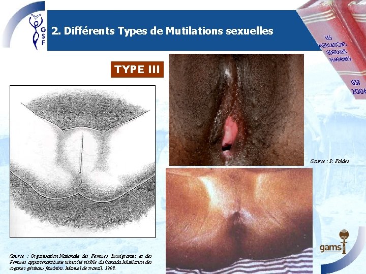 2. Différents Types de Mutilations sexuelles TYPE III Source : P. Foldes Source : 2. Différents Types de Mutilations sexuelles TYPE III Source : P. Foldes Source :