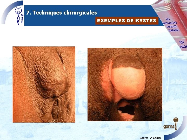 7. Techniques chirurgicales EXEMPLES DE KYSTES (Source : P. Foldes) 