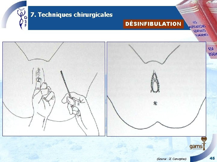 7. Techniques chirurgicales DÉSINFIBULATION (Source : X. Carcopino) 45 