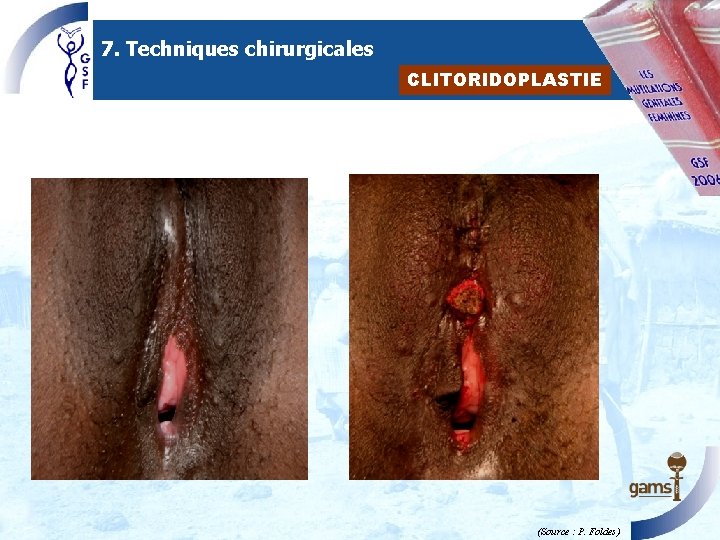 7. Techniques chirurgicales CLITORIDOPLASTIE (Source : P. Foldes ) 7. Techniques chirurgicales CLITORIDOPLASTIE (Source : P. Foldes )