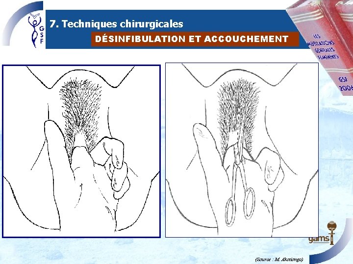 7. Techniques chirurgicales DÉSINFIBULATION ET ACCOUCHEMENT (Source : M. Akotionga) 