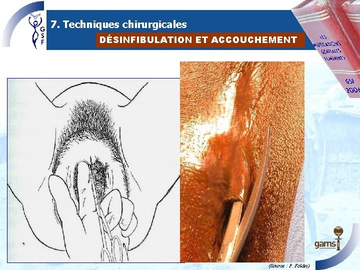 7. Techniques chirurgicales DÉSINFIBULATION ET ACCOUCHEMENT (Source : P. Foldes) 