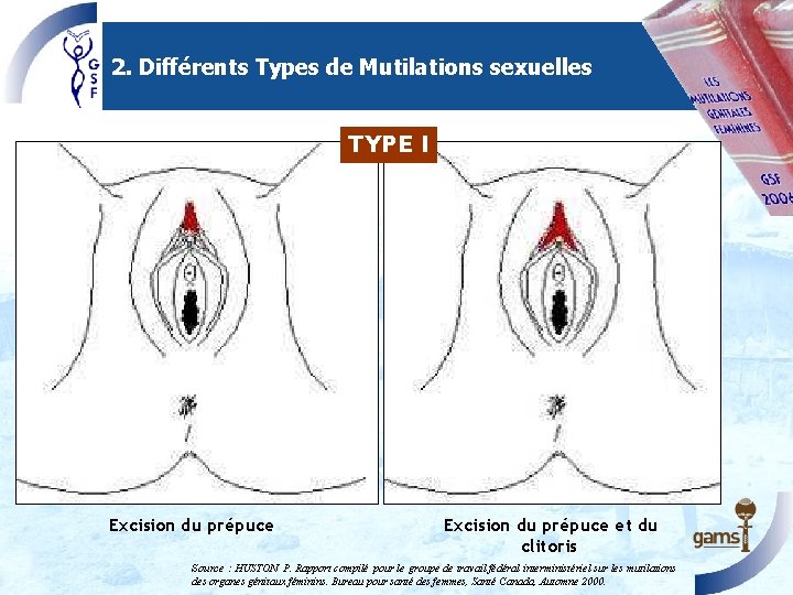 2. Différents Types de Mutilations sexuelles TYPE I Excision du prépuce et du clitoris 2. Différents Types de Mutilations sexuelles TYPE I Excision du prépuce et du clitoris