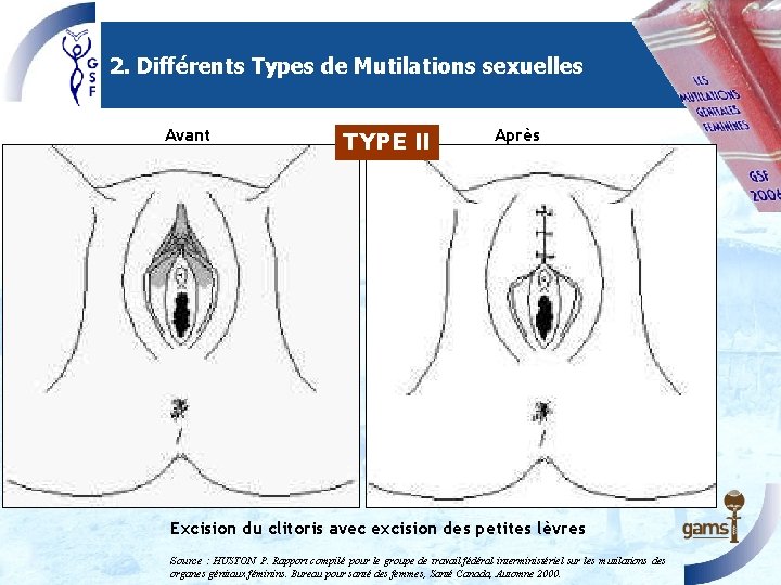 2. Différents Types de Mutilations sexuelles Avant TYPE II Après Excision du clitoris avec