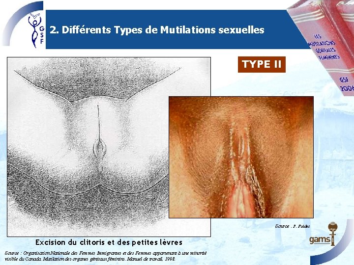 2. Différents Types de Mutilations sexuelles TYPE II Source : P. Foldes Excision du