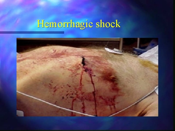 Hemorrhagic shock Hemorrhagic shock