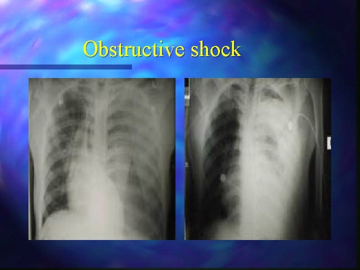 Obstructive shock Obstructive shock