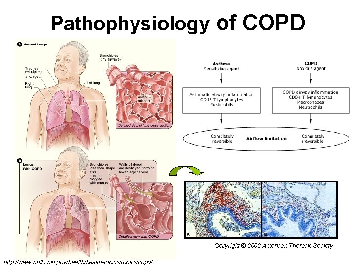 Pathophysiology of COPD Copyright © 2002 American Thoracic Society http: //www. nhlbi. nih. gov/health-topics/copd/