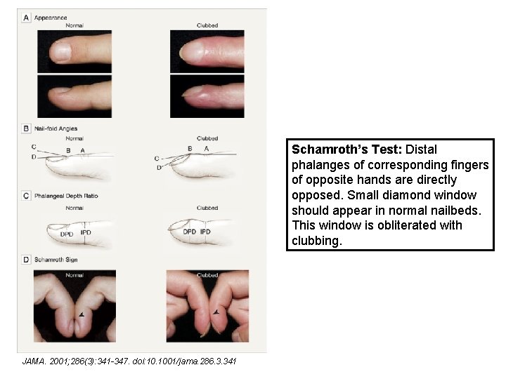Schamroth’s Test: Distal phalanges of corresponding fingers of opposite hands are directly opposed. Small
