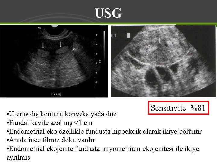 USG Sensitivite %81 • Uterus dış konturu konveks yada düz • Fundal kavite azalmış