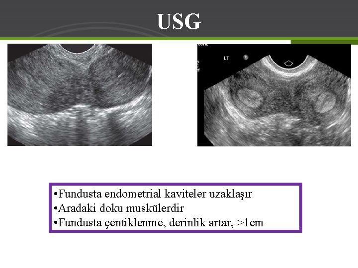 USG • Fundusta endometrial kaviteler uzaklaşır • Aradaki doku muskülerdir • Fundusta çentiklenme, derinlik