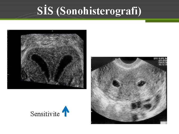 SİS (Sonohisterografi) Sensitivite 