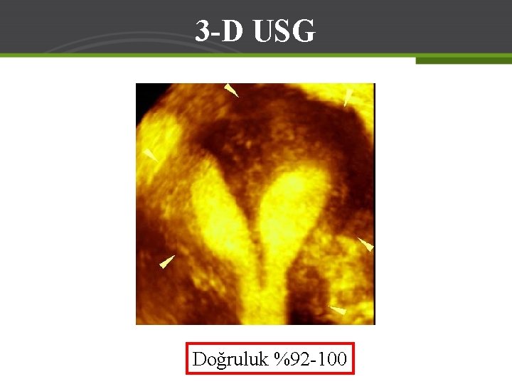 3 -D USG Doğruluk %92 -100 