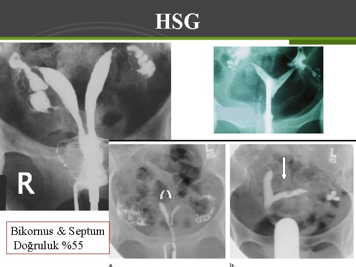 HSG Bikornus & Septum Doğruluk %55 