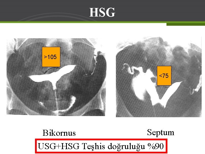 HSG >105 <75 Septum Bikornus USG+HSG Teşhis doğruluğu %90 