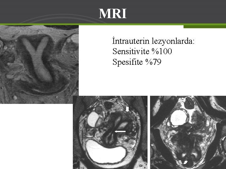 MRI İntrauterin lezyonlarda: Sensitivite %100 Spesifite %79 