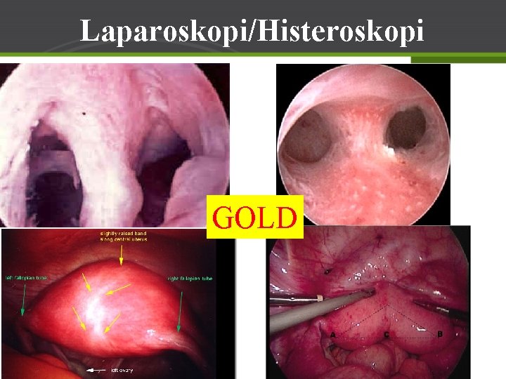 Laparoskopi/Histeroskopi GOLD 