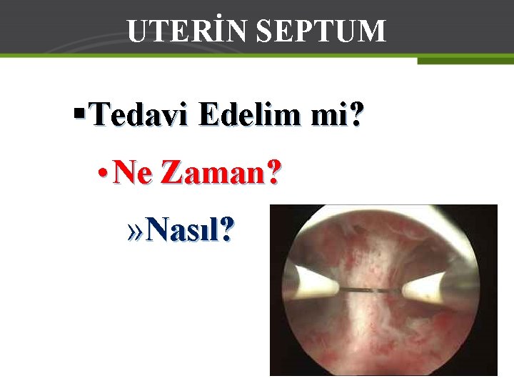 UTERİN SEPTUM §Tedavi Edelim mi? • Ne Zaman? » Nasıl? 