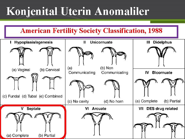 Konjenital Uterin Anomaliler American Fertility Society Classification, 1988 