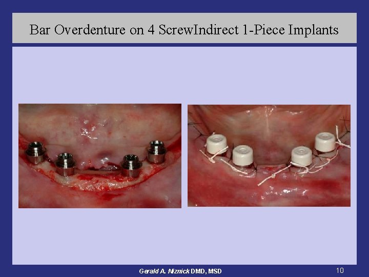 Bar Overdenture on 4 Screw. Indirect 1 -Piece Implants Gerald A. Niznick DMD, MSD