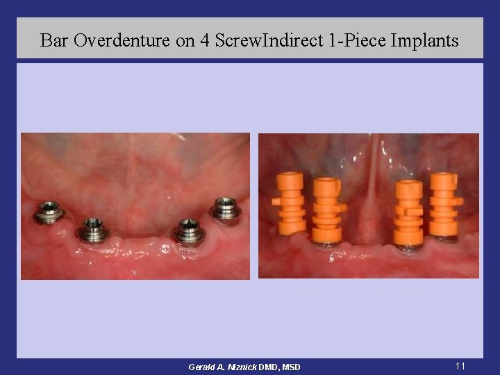 Bar Overdenture on 4 Screw. Indirect 1 -Piece Implants Gerald A. Niznick DMD, MSD