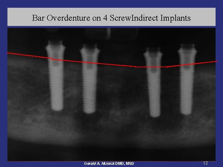 Bar Overdenture on 4 Screw. Indirect Implants Gerald A. Niznick DMD, MSD 12 