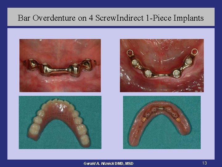 Bar Overdenture on 4 Screw. Indirect 1 -Piece Implants Gerald A. Niznick DMD, MSD