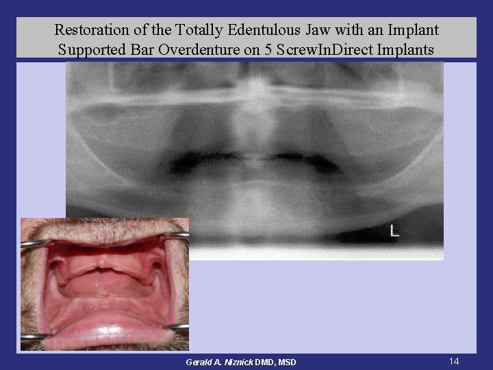 Restoration of the Totally Edentulous Jaw with an Implant Supported Bar Overdenture on 5