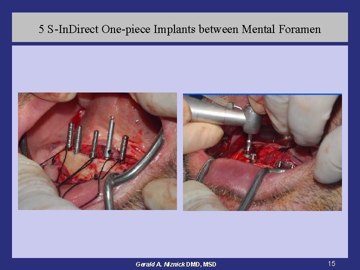 5 S-In. Direct One-piece Implants between Mental Foramen Gerald A. Niznick DMD, MSD 15