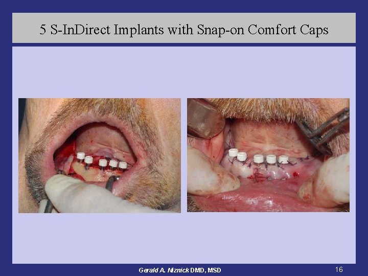 5 S-In. Direct Implants with Snap-on Comfort Caps Gerald A. Niznick DMD, MSD 16