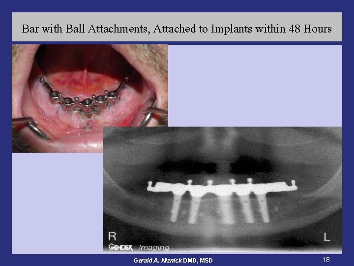 Bar with Ball Attachments, Attached to Implants within 48 Hours Gerald A. Niznick DMD,