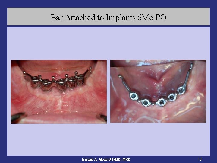 Bar Attached to Implants 6 Mo PO Gerald A. Niznick DMD, MSD 19 