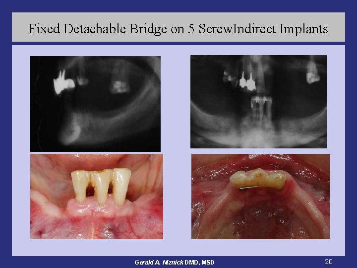 Fixed Detachable Bridge on 5 Screw. Indirect Implants Gerald A. Niznick DMD, MSD 20