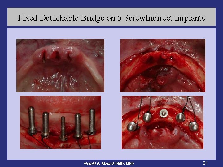 Fixed Detachable Bridge on 5 Screw. Indirect Implants Gerald A. Niznick DMD, MSD 21