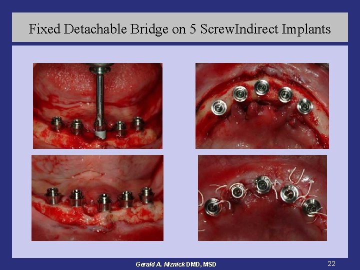 Fixed Detachable Bridge on 5 Screw. Indirect Implants Gerald A. Niznick DMD, MSD 22