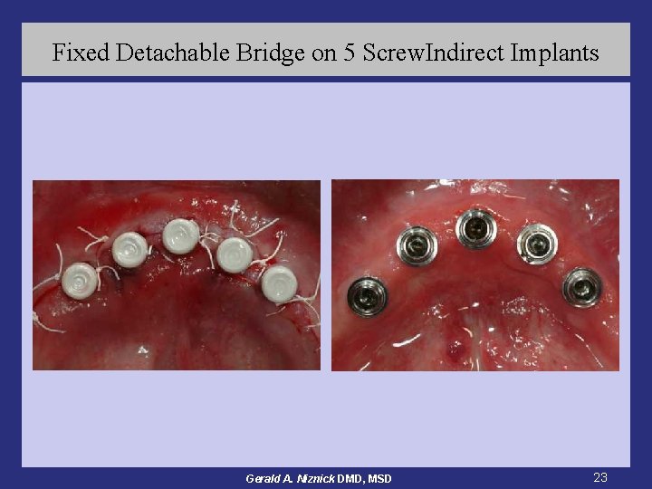 Fixed Detachable Bridge on 5 Screw. Indirect Implants Gerald A. Niznick DMD, MSD 23