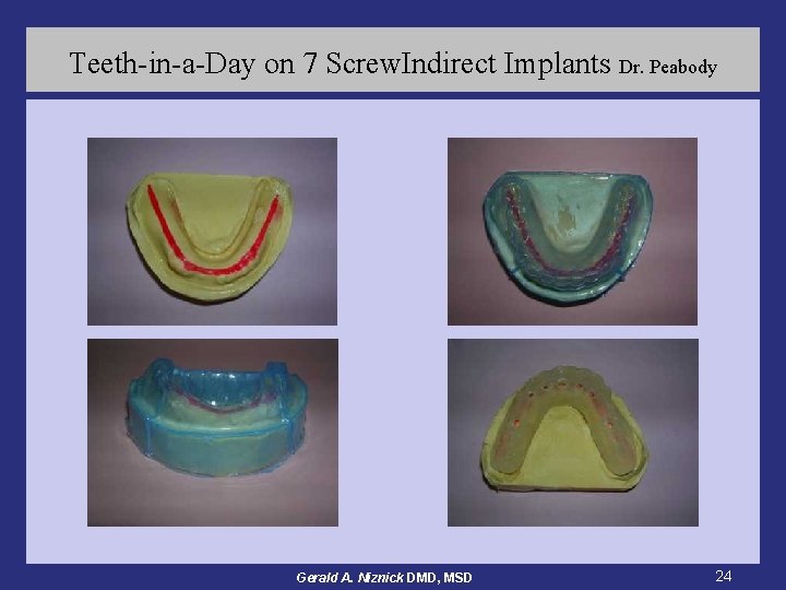 Teeth-in-a-Day on 7 Screw. Indirect Implants Dr. Peabody Gerald A. Niznick DMD, MSD 24