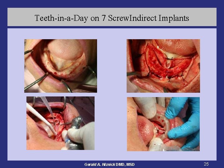 Teeth-in-a-Day on 7 Screw. Indirect Implants Gerald A. Niznick DMD, MSD 25 