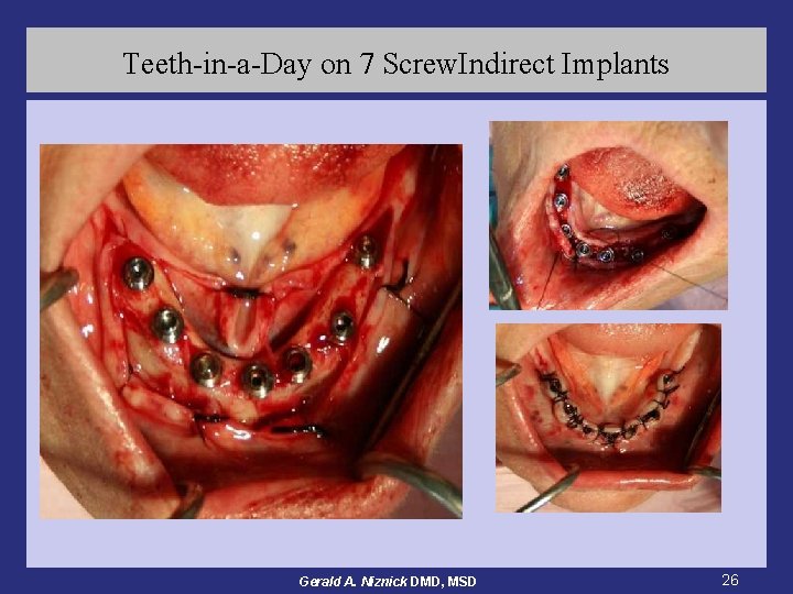 Teeth-in-a-Day on 7 Screw. Indirect Implants Gerald A. Niznick DMD, MSD 26 