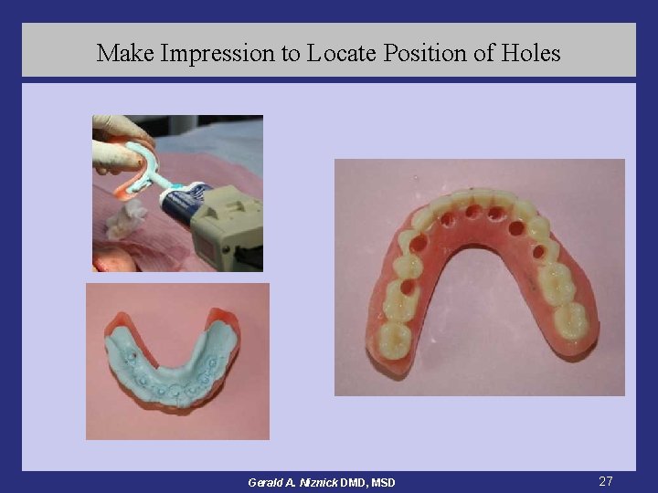 Make Impression to Locate Position of Holes Gerald A. Niznick DMD, MSD 27 