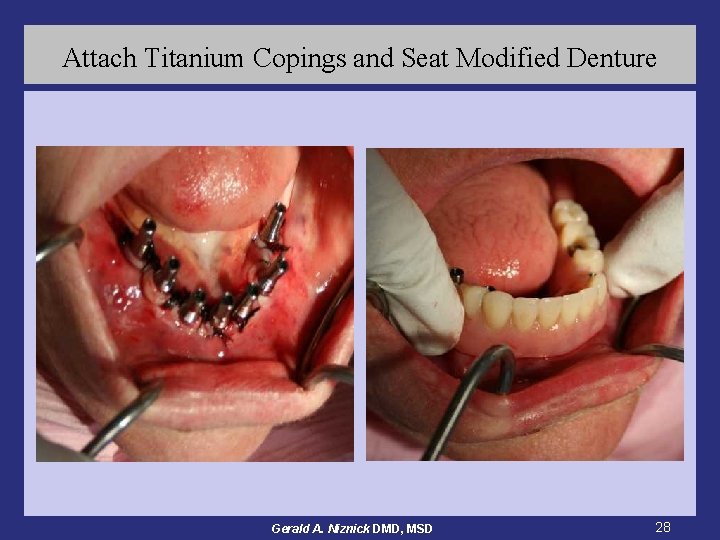 Attach Titanium Copings and Seat Modified Denture Gerald A. Niznick DMD, MSD 28 