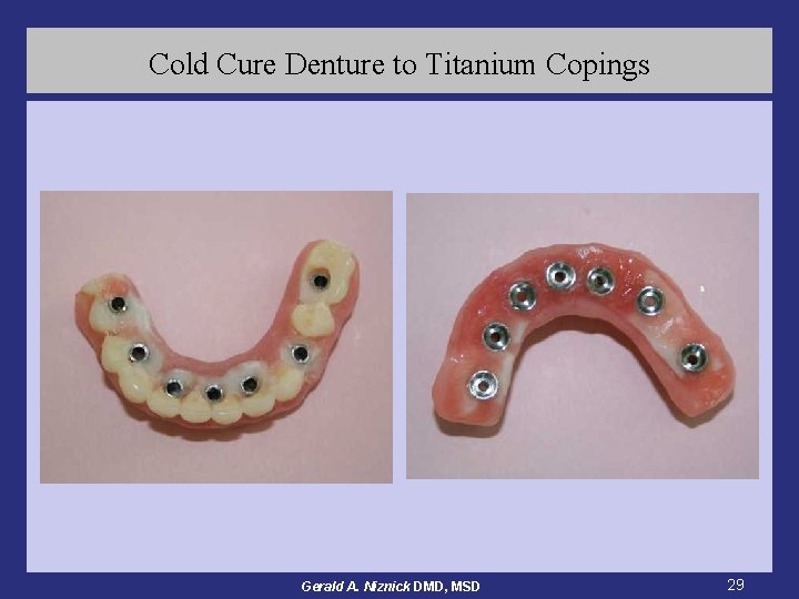 Cold Cure Denture to Titanium Copings Gerald A. Niznick DMD, MSD 29 