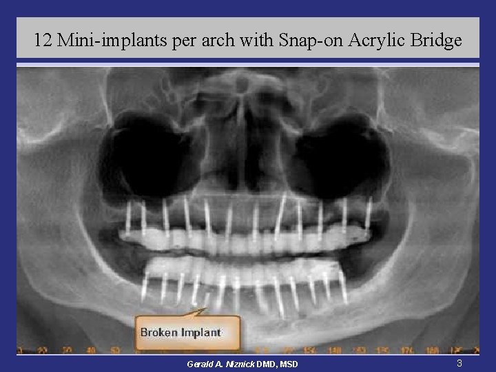 12 Mini-implants per arch with Snap-on Acrylic Bridge Gerald A. Niznick DMD, MSD 3