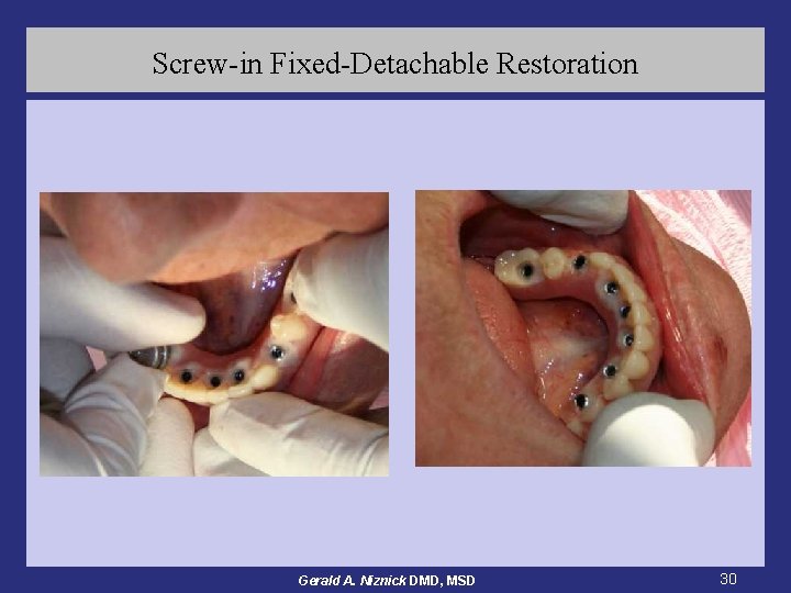 Screw-in Fixed-Detachable Restoration Gerald A. Niznick DMD, MSD 30 