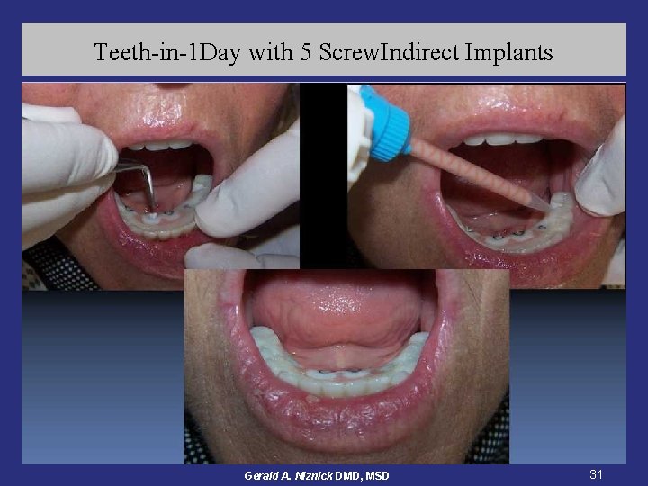 Teeth-in-1 Day with 5 Screw. Indirect Implants Gerald A. Niznick DMD, MSD 31 