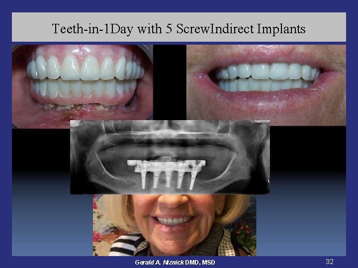 Teeth-in-1 Day with 5 Screw. Indirect Implants Gerald A. Niznick DMD, MSD 32 